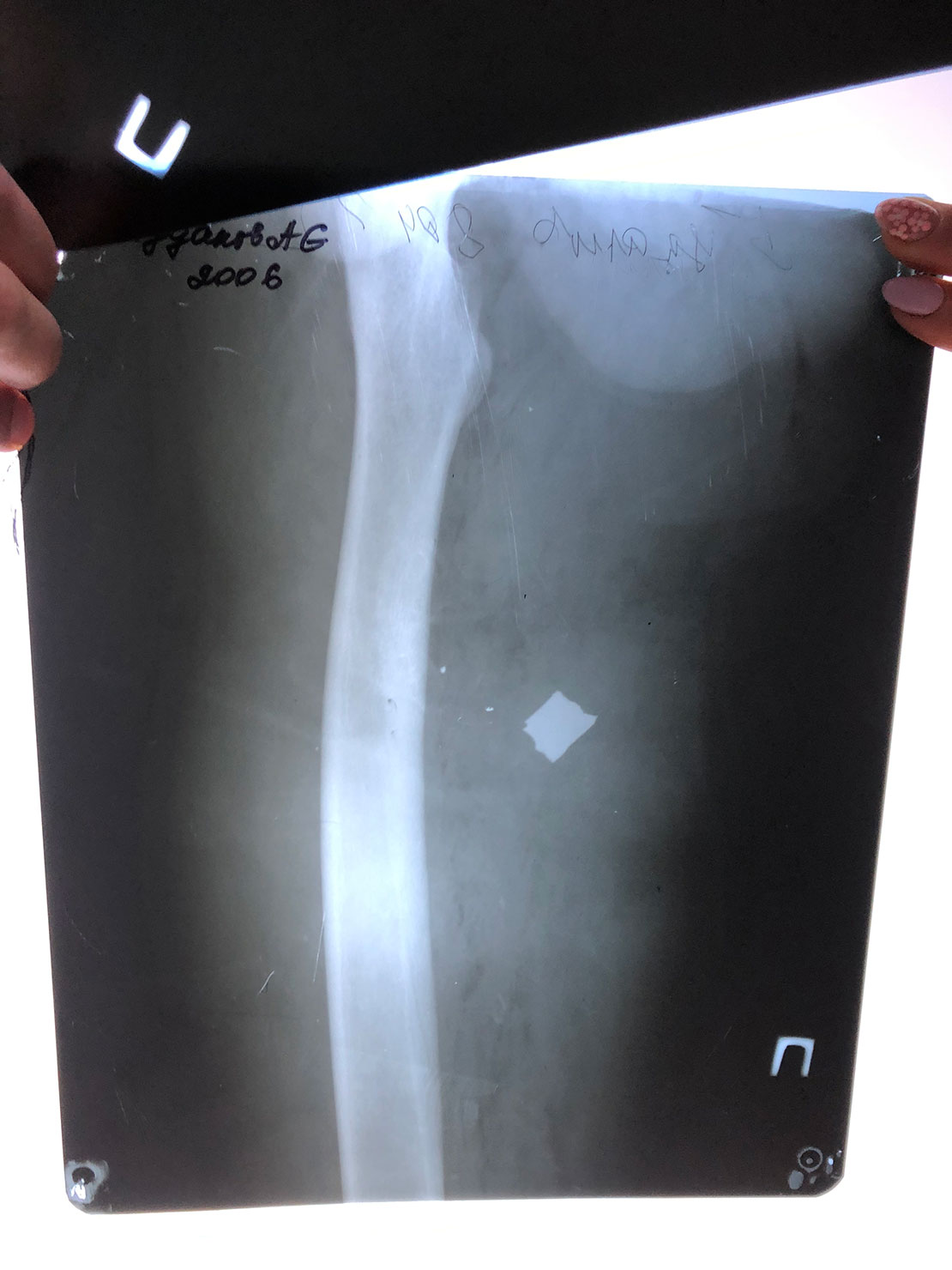 x-ray